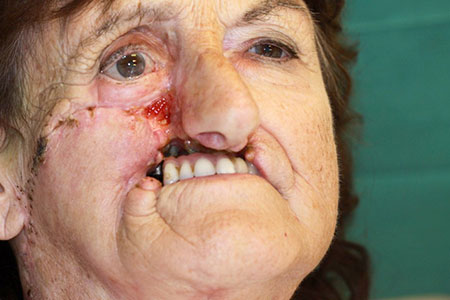 Fig.3 a. 68 år gammel kvinne med høyresidig maxillecancer tidligere rekonstruert med crista iliacalapp. Grunnet leppe-og kinndefekt ble hun senere rekonstruert med radialislapp.
